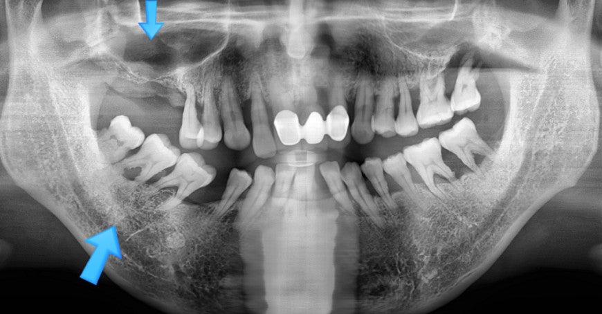 上顎洞挙上手術とは？？/フォシャールプラント歯科の記事より
