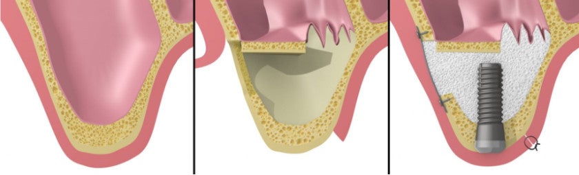 上顎洞挙上手術とは？？/フォシャールプラント歯科の記事より