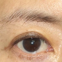 画像 眉下リフト（眉下切開）　術後7ヵ月　＆　眉下リフトにおける眼輪筋切除の是非 の記事より 4つ目