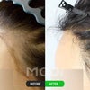 「白髪の毛髪移植」モディヘアプラントでは非切開法白髪の自毛植毛が可能です❕(事例)の画像