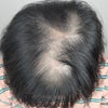 脱毛症治療薬ミノキシジル(外用薬・内服薬)とは❓の画像