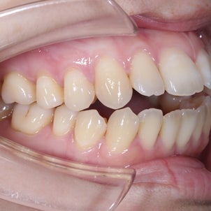 初診時年齢28歳　女性　開咬・上顎前突が主訴　小臼歯４本抜歯によるブラケット治療が終了の画像