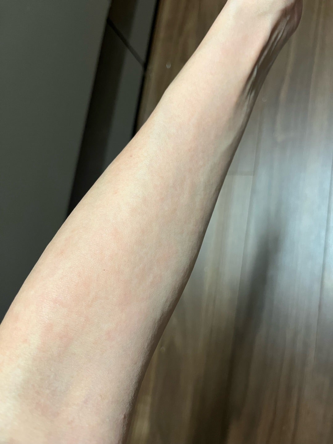 蕁 麻疹 妊娠 初期