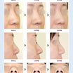 【症例紹介】鼻尖形成術；耳介軟骨移植術＋鼻尖縮小術