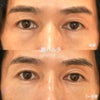 裏ハムラ法手術～ダウンタイムの短い下瞼のクマ取り手術～の画像