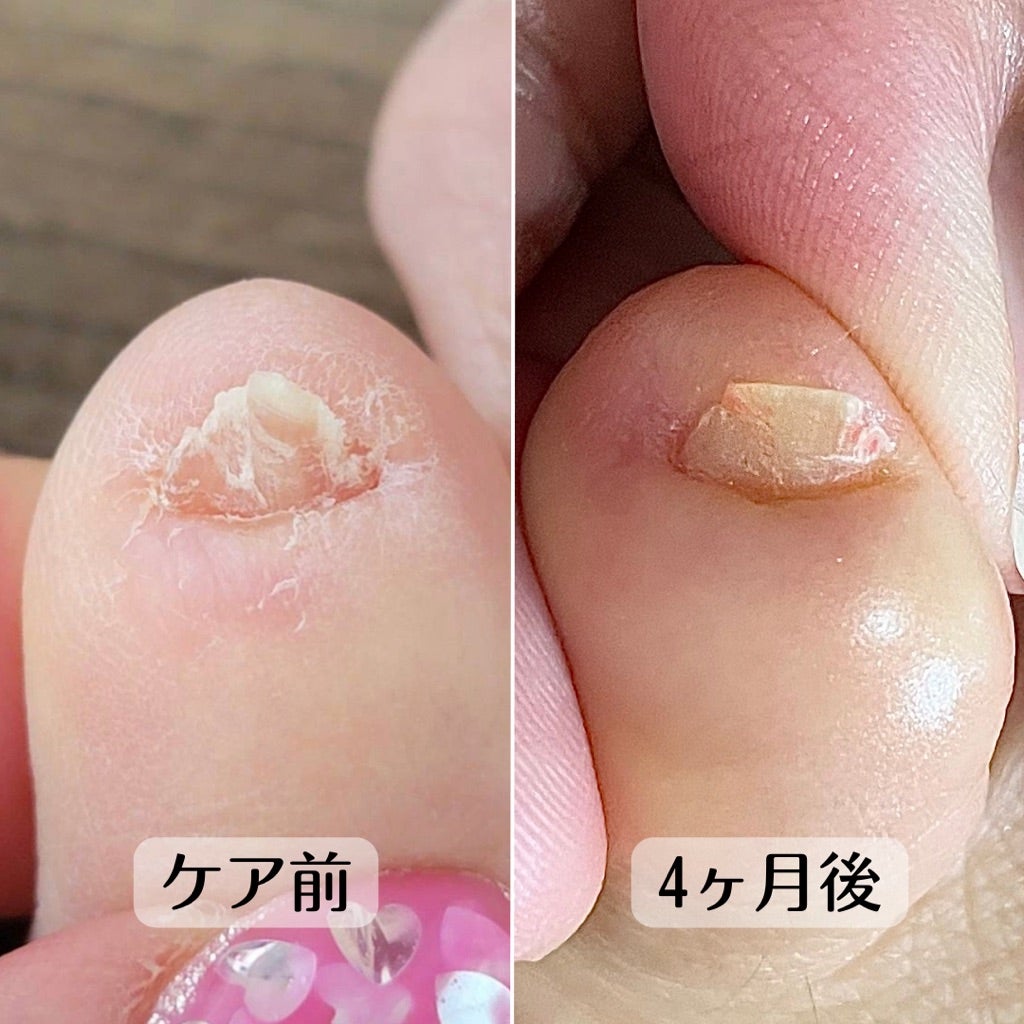小指の爪が潰れているこんな爪でも変わりますか？ | 京都