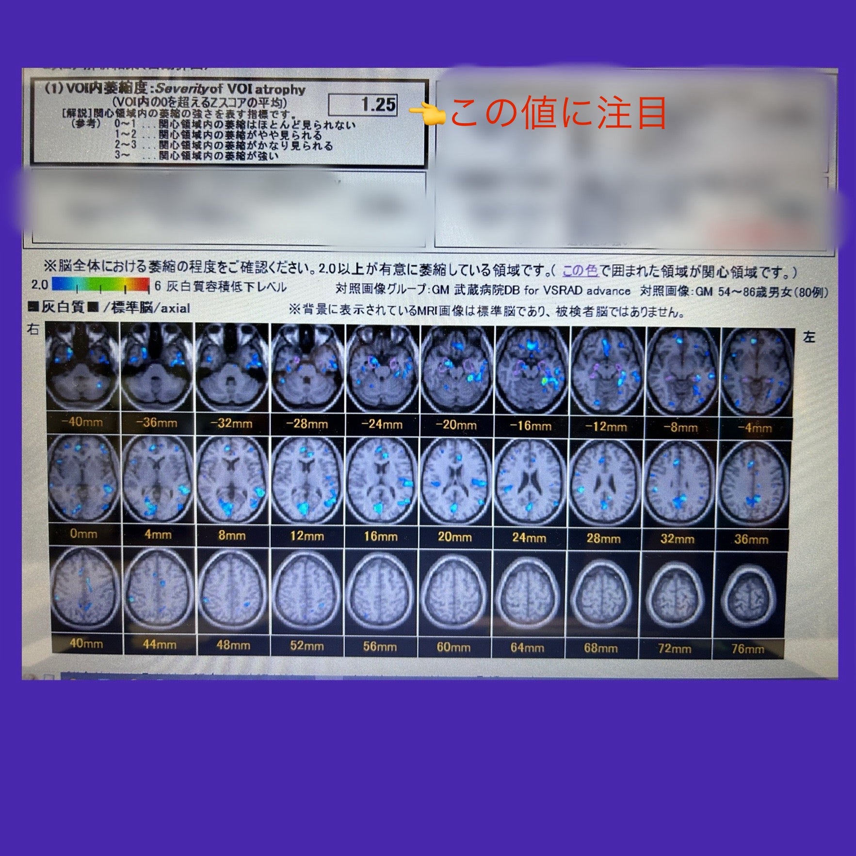 頭部MRIは、認知症の診断にどこまで迫れるか?~VSRADについて 頭部MRIは、認知症の診断にどこまで迫れるか?~VSRADについて