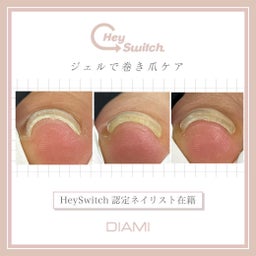 画像 足の巻き爪ケア HeySwitch ヘイスイッチで足が軽くはさ の記事より 10つ目