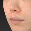 ２０代女性「貴族手術（鼻翼基部プロテーゼ）」手術後３ヶ月目の変化です。の画像