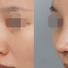 鷲鼻と矢印鼻を改善 女性らしい鼻先とすっきりした鼻筋への画像