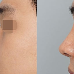 画像 男性の鼻整形で重要な眉間と鼻先のバランス✨ の記事より 1つ目