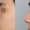 男性の鼻整形で重要な眉間と鼻先のバランス✨の画像