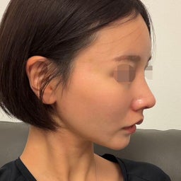 画像 鷲鼻と矢印鼻を改善 女性らしい鼻先とすっきりした鼻筋へ の記事より 3つ目