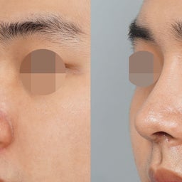 画像 男性の鼻整形で重要な眉間と鼻先のバランス✨ の記事より 3つ目