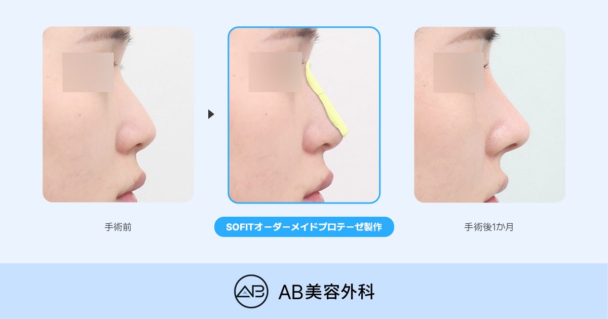 SOFIT（ソフィット）鼻整形とは？一般的なプロテーゼとの違いとオーダーメイドプロテーゼが適しての記事画像