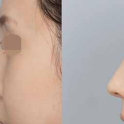 画像 溶けないカルシウムフィラーが入った鼻…短く見える鼻先を自然に改善✨ の記事より 3つ目