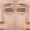 溶けないカルシウムフィラーが入った鼻…短く見える鼻先を自然に改善✨の画像