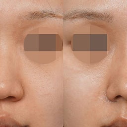 画像 なぜ鼻先は広がって下がる？ 土台から整える鼻先改善 の記事より 2つ目