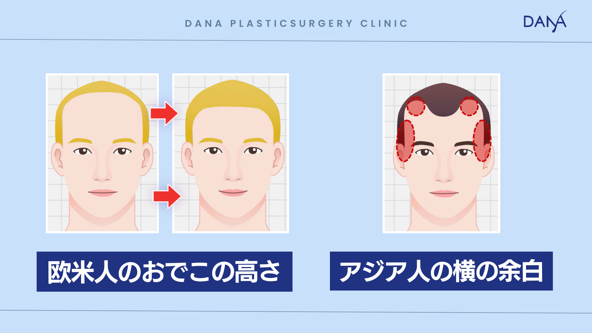 ヘアライン矯正植毛、実は小顔の手術？｜アジア人の顔立ちと植毛のお話の記事画像