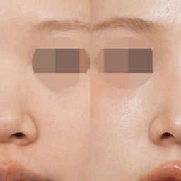 画像 肋軟骨を使った中顔面の補強鼻整形｜団子鼻・口元の突出感を改善✨ の記事より 2つ目