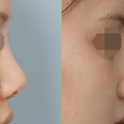 画像 プロテーゼ除去＋肋軟骨による鼻再手術✨不自然な鼻筋と鼻先の角度・鼻柱を改善 の記事より 1つ目
