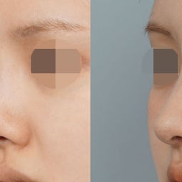 画像 プロテーゼ除去＋肋軟骨による鼻再手術✨不自然な鼻筋と鼻先の角度・鼻柱を改善 の記事より 4つ目