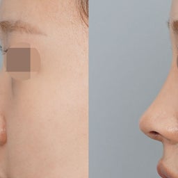 画像 肋軟骨を使った中顔面の補強鼻整形｜団子鼻・口元の突出感を改善✨ の記  事より 1つ目