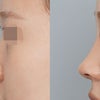肋軟骨を使った中顔面の補強鼻整形｜団子鼻・口元の突出感を改善✨の画像