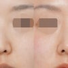 ハンプ＋下がった鼻先を自然に改善✨ 肋軟骨を使わずに整えた鼻整形の画像