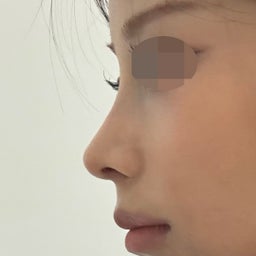 画像 低い鼻筋と広がった鼻先を改善｜肋軟骨を使用した鼻整形 の記事より 3つ目