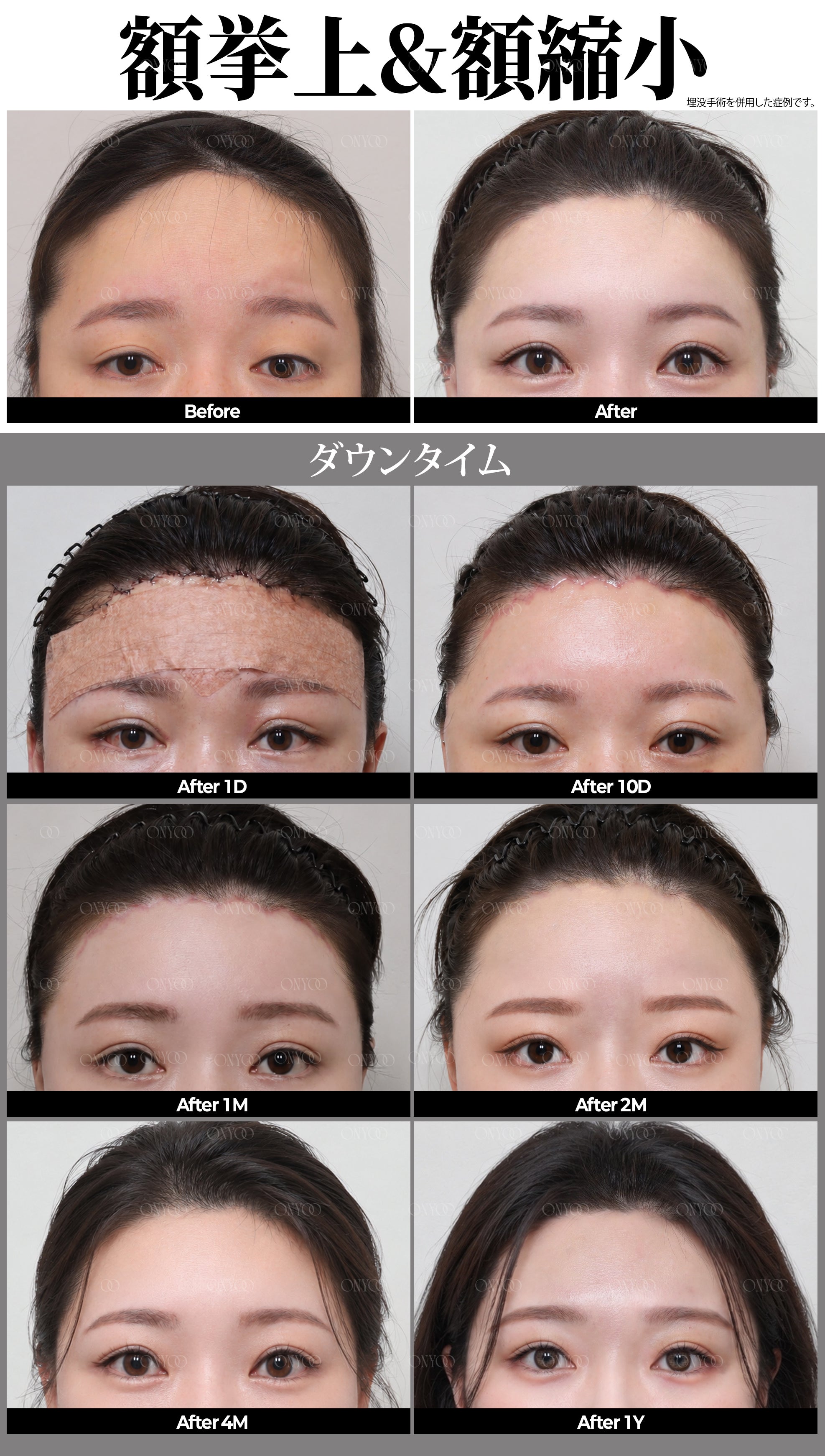 ルラ美容クリニックからお越しの皆様へ｜韓国オンユ美容整形外科のご紹介と特別優待のご案内の記事画像