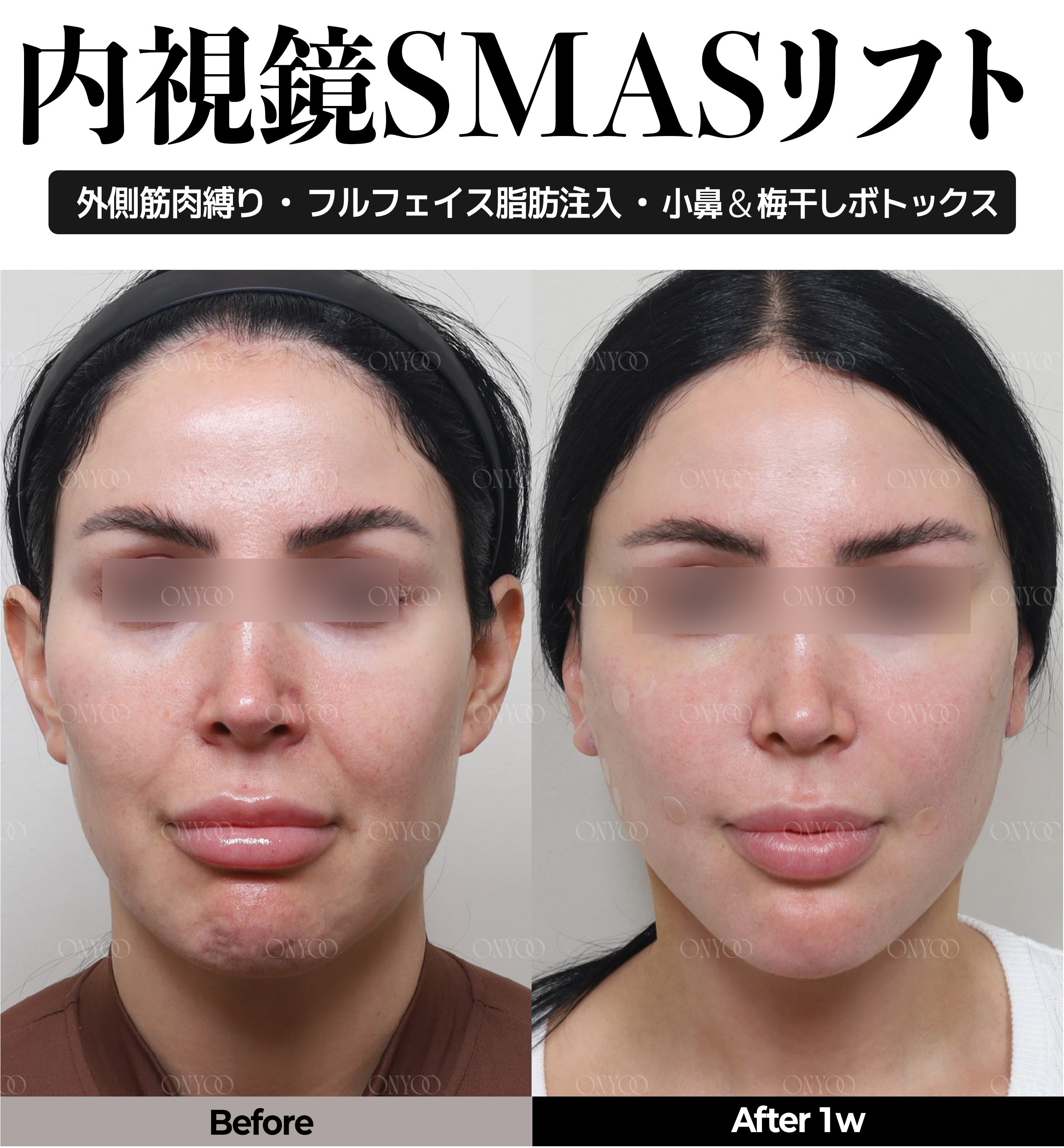 ルラ美容クリニックからお越しの皆様へ｜韓国オンユ美容整形外科のご紹介と特別優待のご案内の記事画像