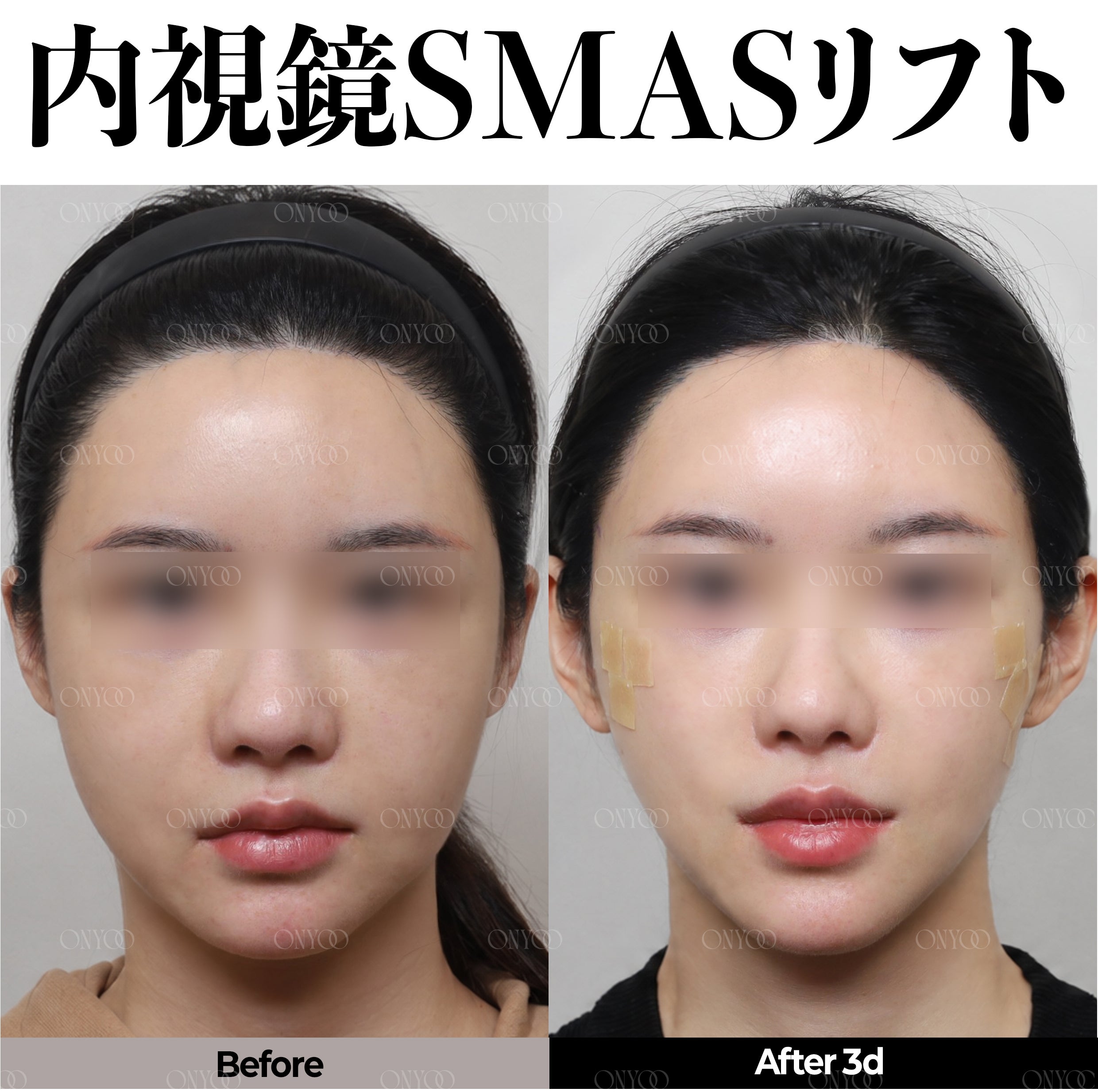 ルラ美容クリニックからお越しの皆様へ｜韓国オンユ美容整形外科のご紹介と特別優待のご案内の記事画像