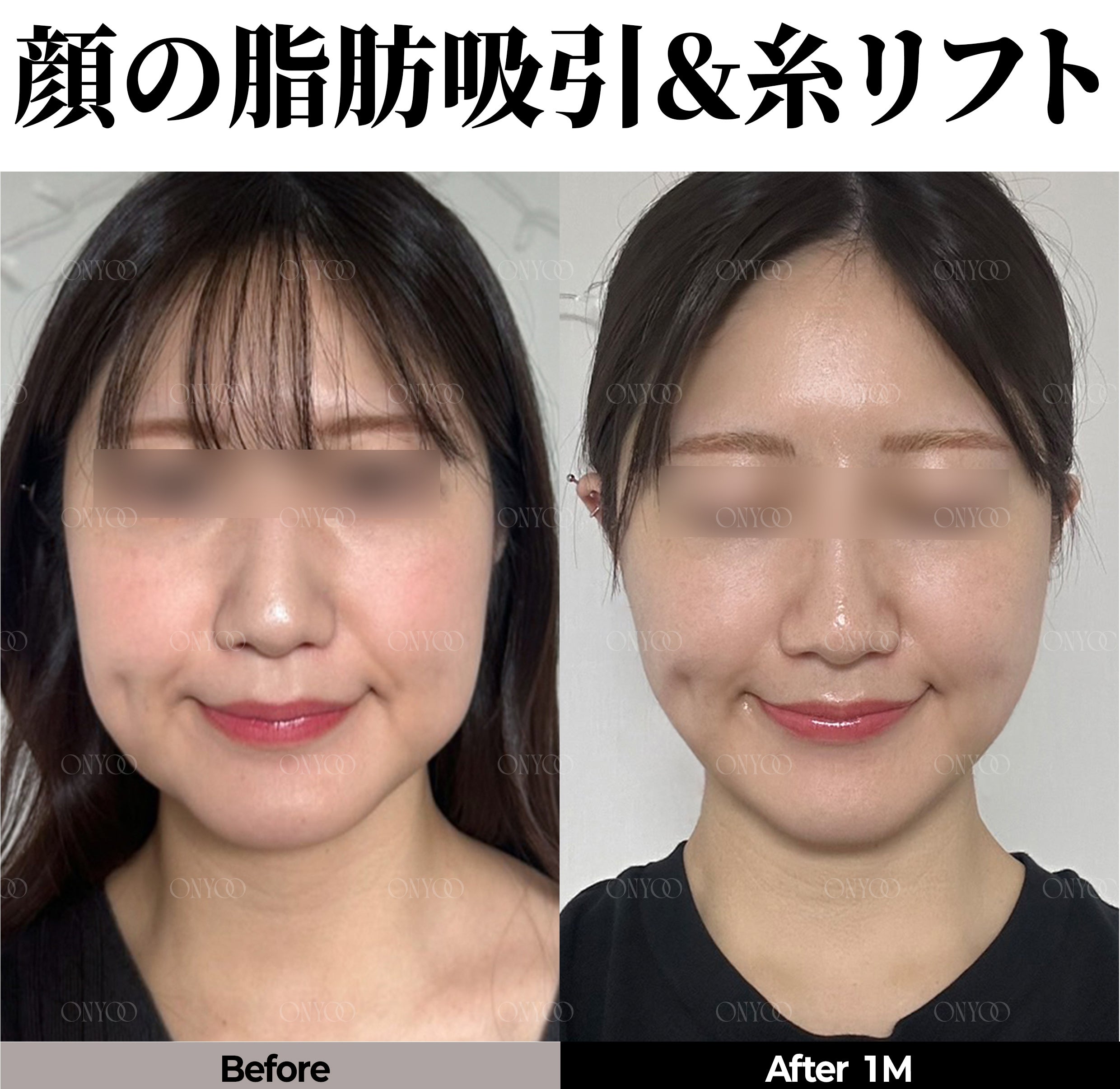 ルラ美容クリニックからお越しの皆様へ｜韓国オンユ美容整形外科のご紹介と特別優待のご案内の記事画像