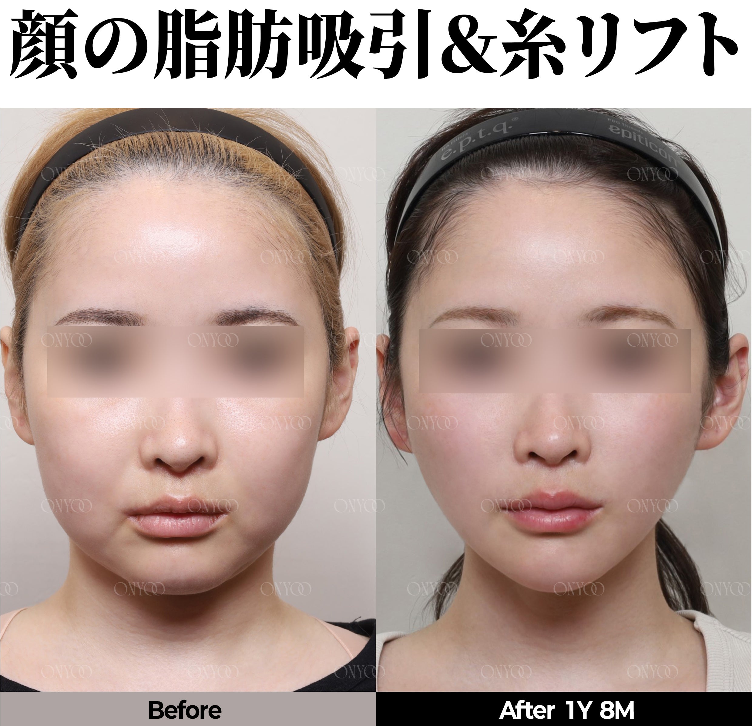 ルラ美容クリニックからお越しの皆様へ｜韓国オンユ美容整形外科のご紹介と特別優待のご案内の記事画像