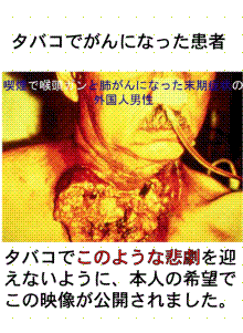 末期癌