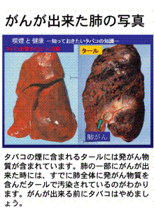 肺癌