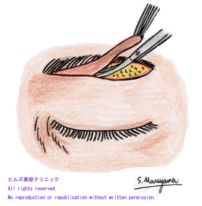 目の上のたるみ～眉毛下切開法（上眼瞼リフト）～の記事より