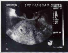 5weeks ultra sound