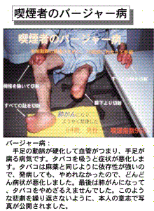 バージャー病