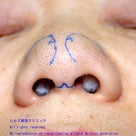 だんご鼻の修正 ②〜鼻尖縮小術の記事より