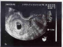 7weeks ultra sound